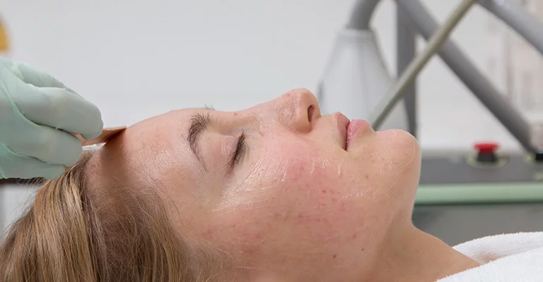 peeling faciales profecionales