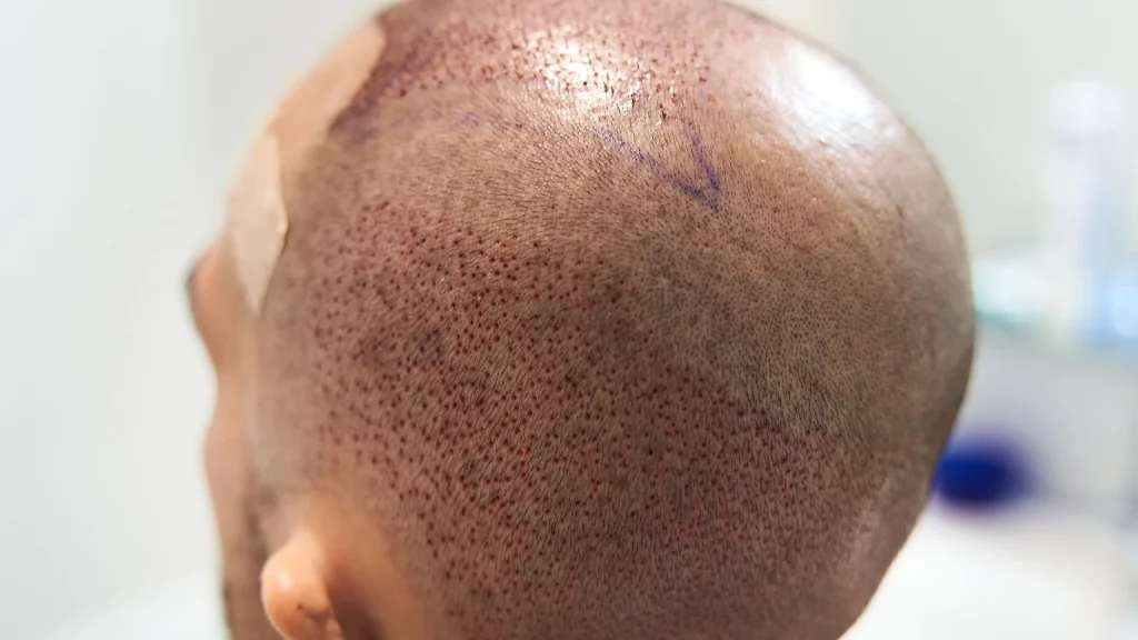El crecimiento del cabello después de un injerto capilar es un proceso gradual.