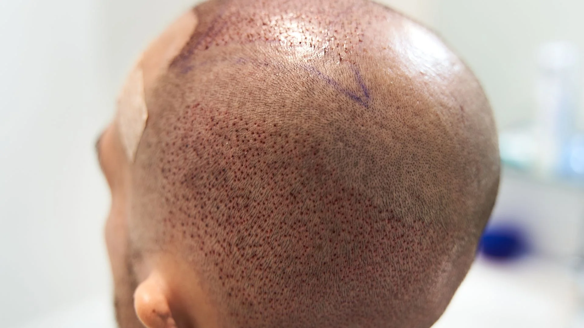 El crecimiento del cabello después de un injerto capilar es un proceso gradual.