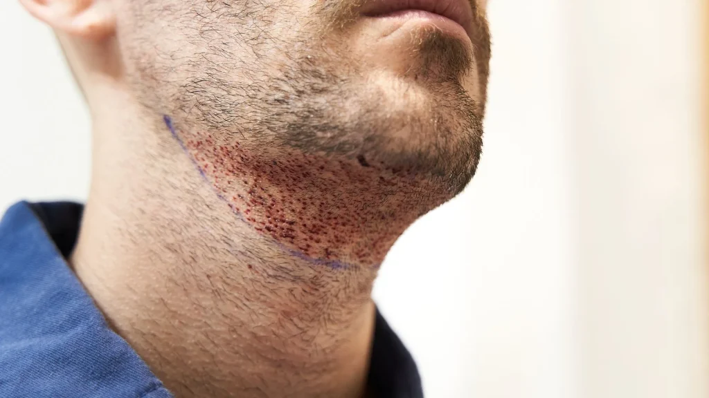 Transforma tu rostro con un injerto de barba y cejas.