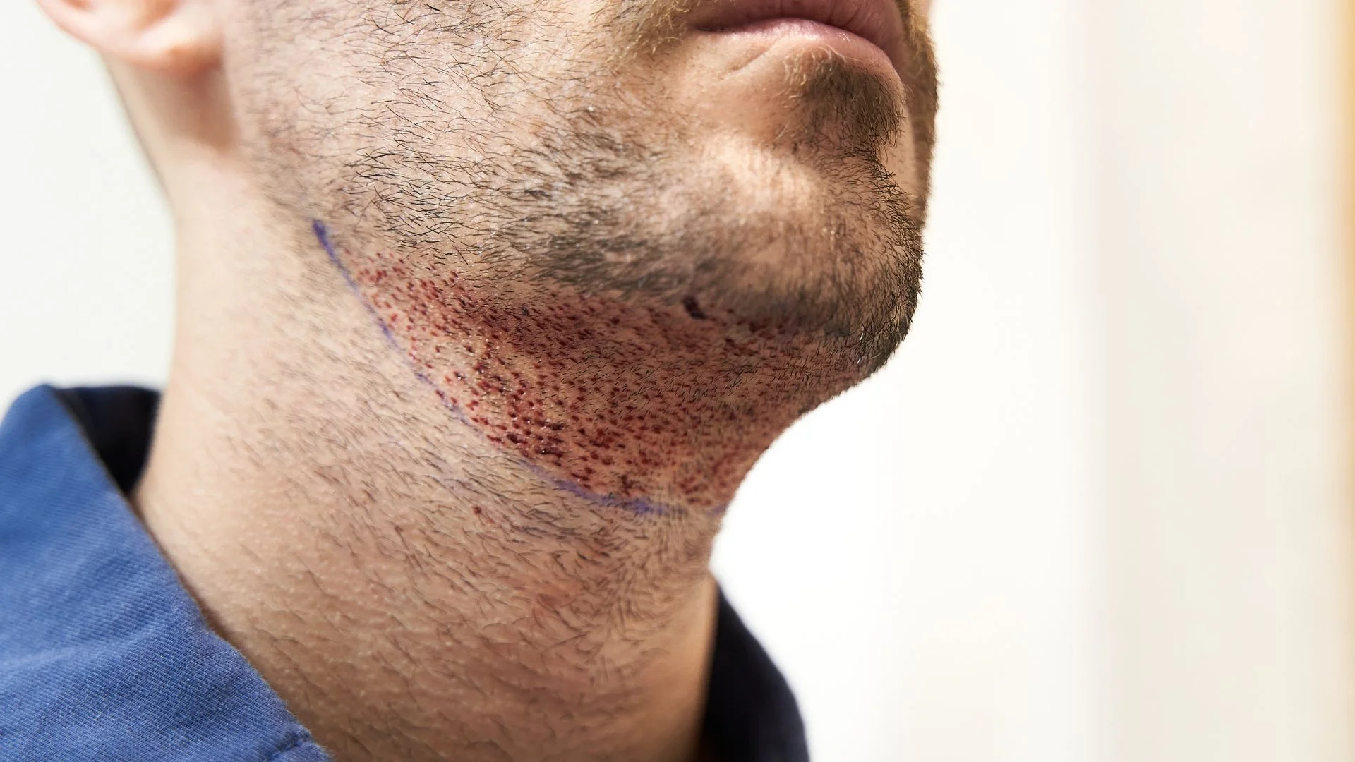 Transforma tu rostro con un injerto de barba y cejas.