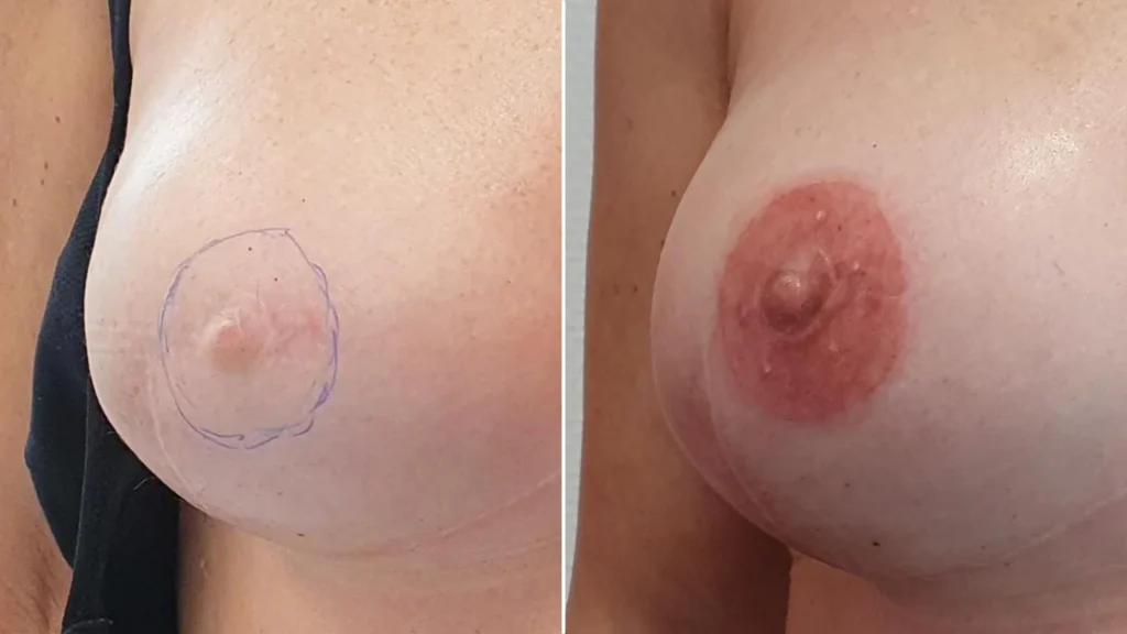 Micropigmentación de areolas: devolviendo la feminidad con precisión.